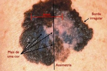Carcinoma basocelular Carcinoma basocelular